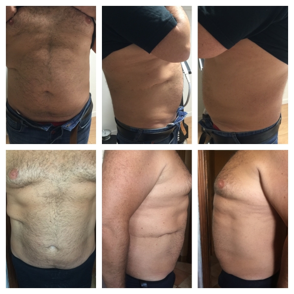 Resultats  6 semaines apres avec une seance 1 zone traitée